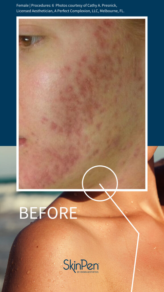 SkinPen®Microneedling
