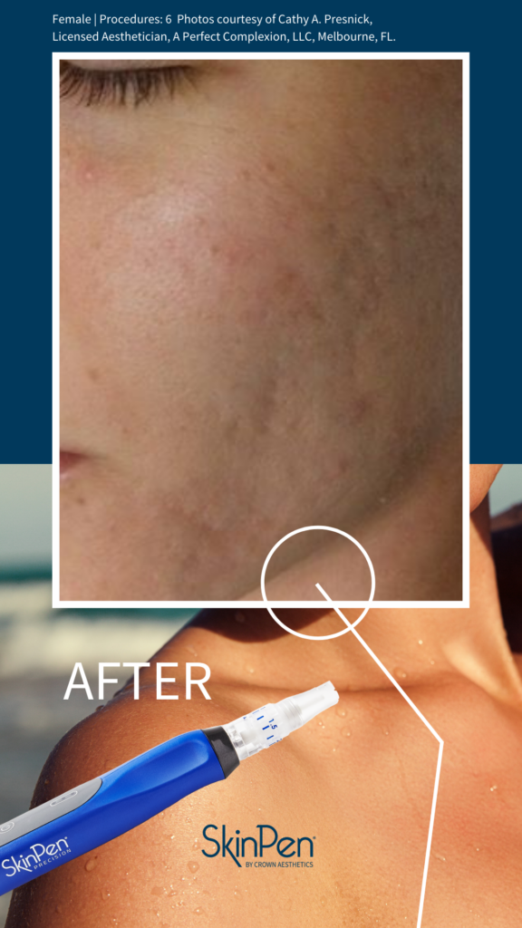 SkinPen®Microneedling