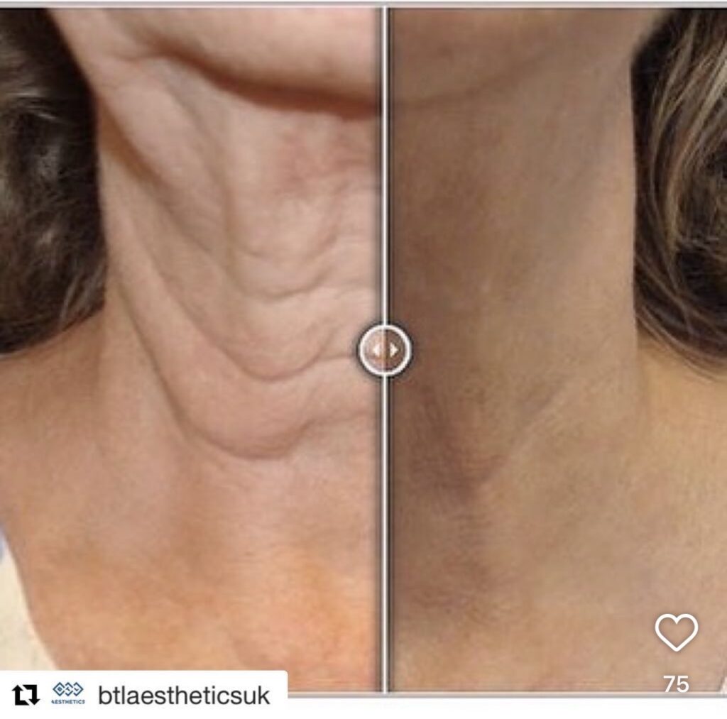  Chemical Peels