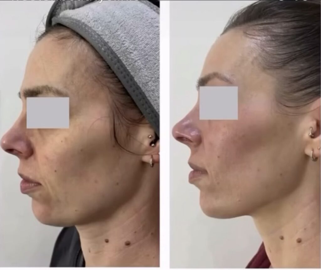  Chemical Peels
