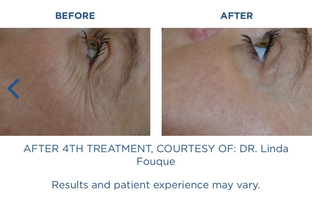  Chemical Peels