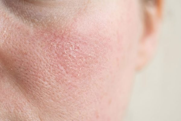 Skin Conditions