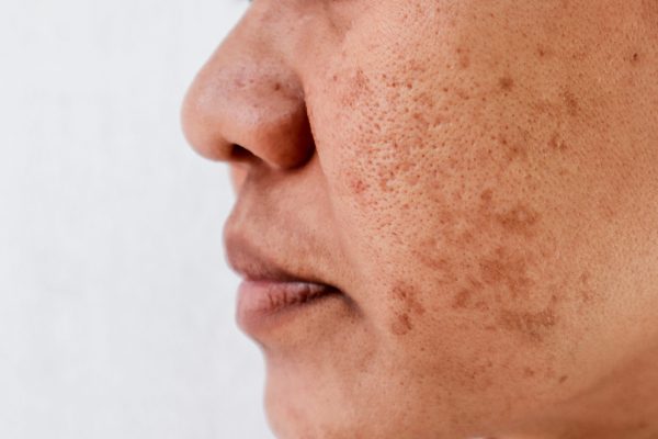 Skin Conditions