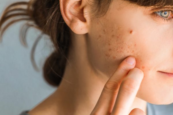 Skin Conditions