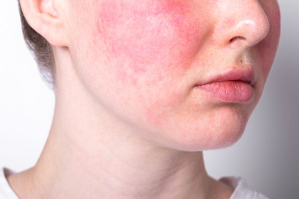 Skin Conditions